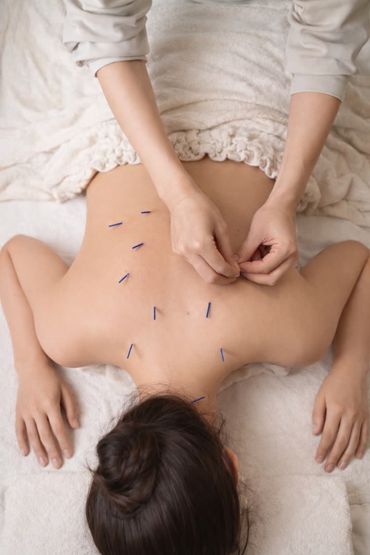 鍼灸施術の様子